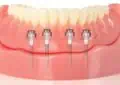 How Much Do Mini Dental Implants Cost? Explore Benefits And Considerations