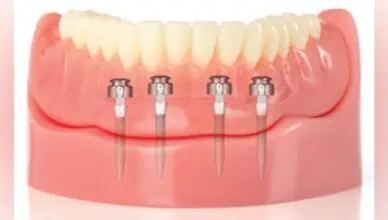 Mini Dental Implants