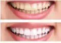 How Much Does Teeth Whitening Cost?