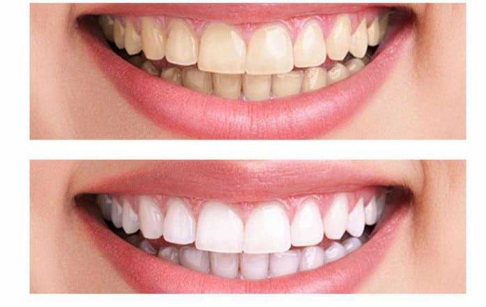 Teeth Whitening Cost
