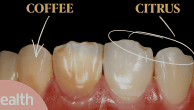 yellow teeth
