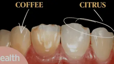 yellow teeth