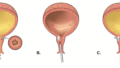 Urinary Incontinence Surgery